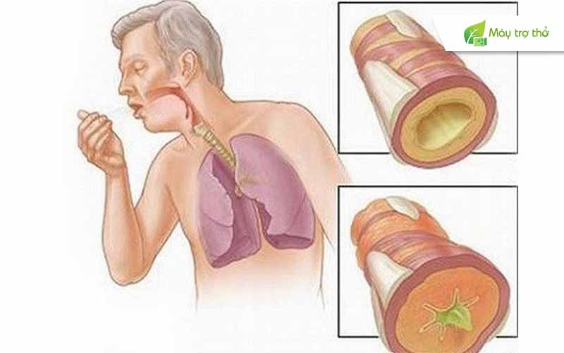 Viêm đường hô hấp là một trong những nguyên nhân gây ra hiện tượng ho ở người cao tuổi.
