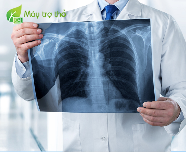 Chụp X-quang là xét nghiệm chẩn đoán tình trạng khó thở phổ biến